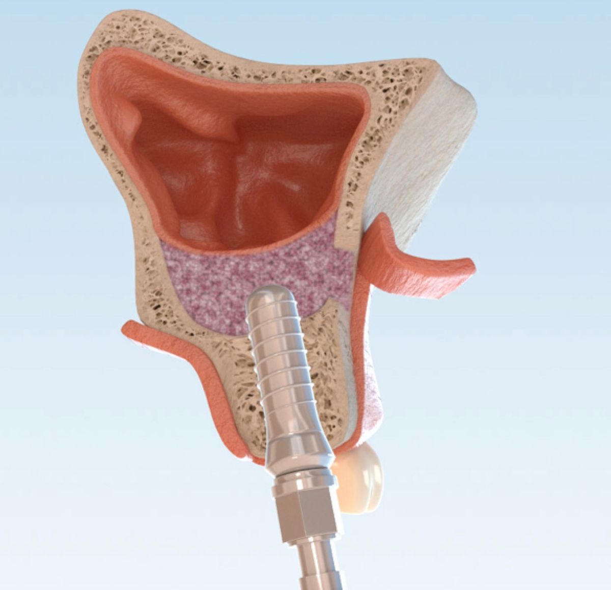 Simultan eingebrachtes Implantat