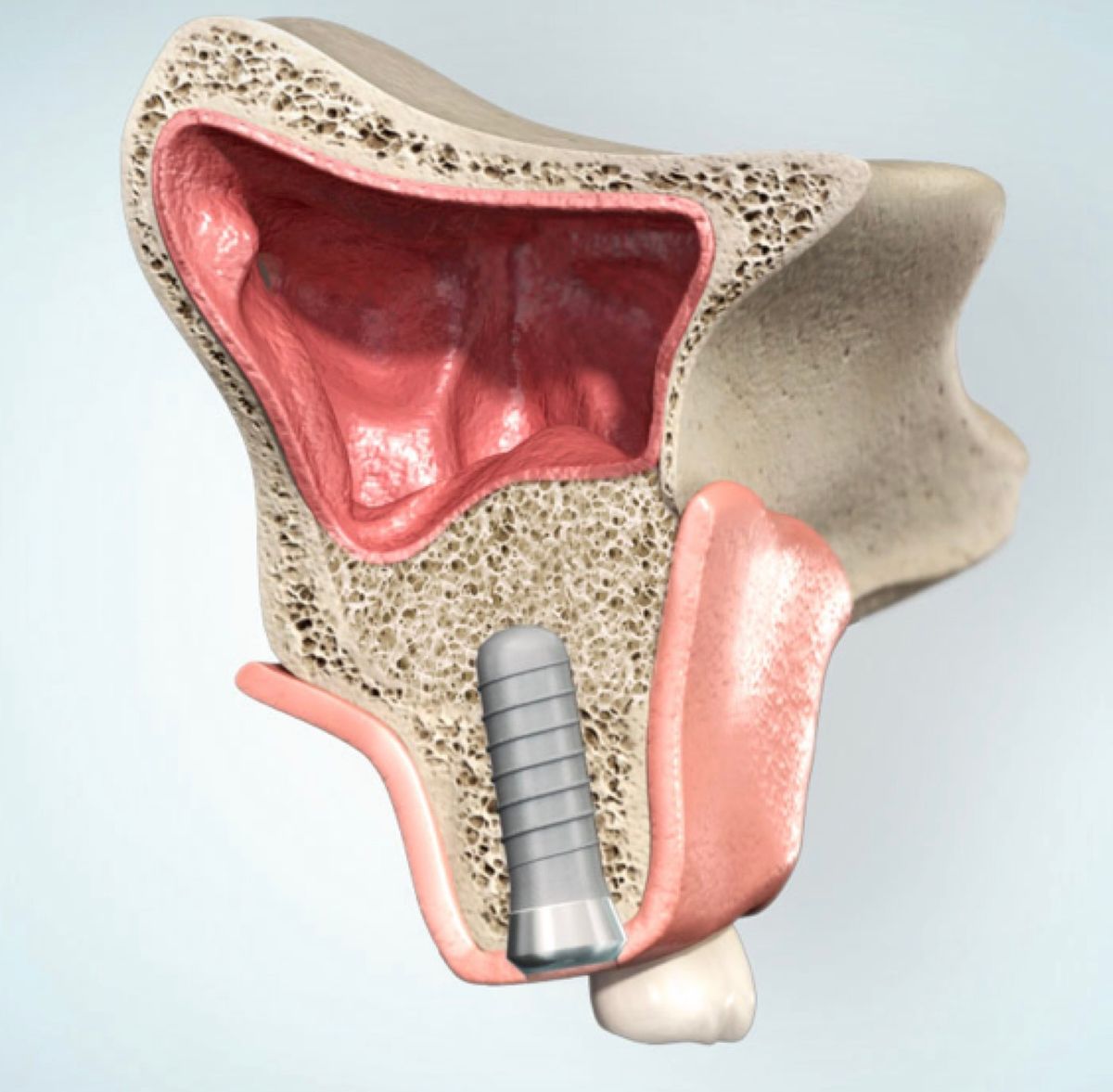 Nach Einheilzeit von sechs Monaten eingebrachtes Implantat